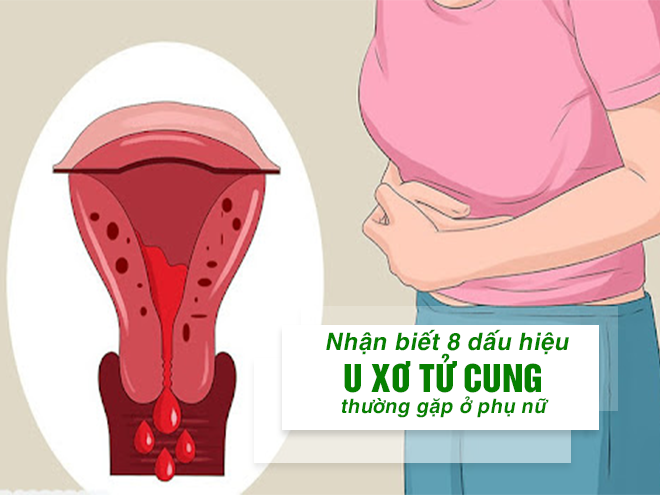 Nhận biết 8 dấu hiệu u xơ tử cung thường gặp ở phụ nữ